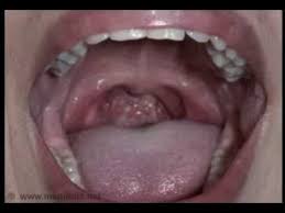 An early indication of oral and throat cancer is one or more changes in the way the soft tissues of the mouth usually look or feel. Strep Throat Symptoms Sore Throat Remedies Lump In Of Throat Cancer Youtube