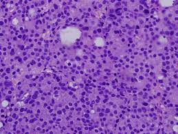 The medical record mentions the type or histology of the cancer, but is not specifically referencing the pathology report or the cytology report. Pathology Outlines Adenocarcinoma