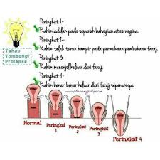 Selalunya waktu petang lepas asar badan rasa nak demam, kaki tangan rasa sejuk. Prolapse Peranakan Jatuh Rahim Kembang Tombong Peranakan Rendah Shopee Malaysia