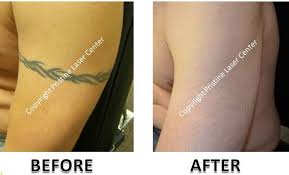 Tribal tattoos in africa are a vast topic to discover. Before And After Laser Tattoo Removal Orlando Pristine Laser Center Pristine Laser Center Orlando