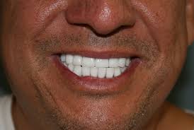 As an adult, is overbite in fact one in five orthodontic correction patients are adults wishing to correct a lifetime of crooked or. Underbite And Overbite Correction Without Surgery