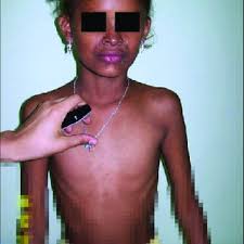 Niña afectada por displasia ectodérmica. Nótese ausencia mamilar