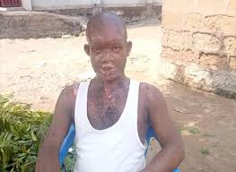 Woman absconds after she allegedly poured acid