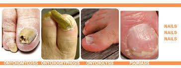 Image result for Onychogryphosis feet