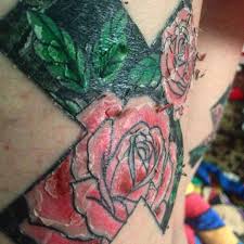Tattoo Peeling Treatment And Minimizing Saniderm