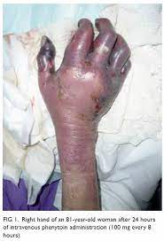 Purple Glove Syndrome Caused By Intravenous Phenytoin Two Case Reports Hkmj