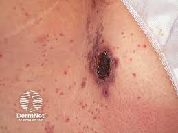 Image result for skin rash acute hiv infection