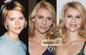 Esposito, 41, came up with the idea after she was . Celebrity Plastic Surgery Beautyenhancement Wordpress Com Beautyenhancement Wordpress Com Offers Various Story Of Celebrity Plastic Surgery Before And After Photos