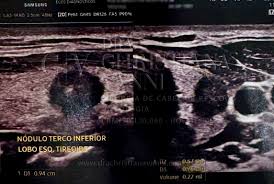 TI-RADS 5 é Câncer? O Que Significa?