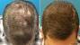Before And After Laser Cap