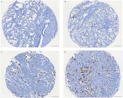It's main causes are alzheimer's, crohn's/colitis, pancreatic cancer, testicular cancer and domestic violence awareness. M2 Macrophages And Regulatory T Cells In Lethal Prostate Cancer Erlandsson 2019 The Prostate Wiley Online Library