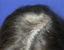 Image result for Alopecia