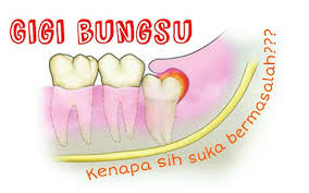 Karena gigi geraham kerjanya paling berat. Pengalaman Mencabut Gigi Bungsu Yang Berlubang Shezahome