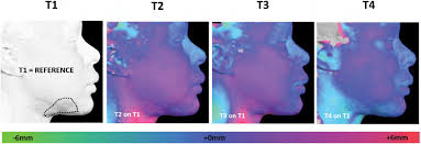 There is, however, a change that occurs in the body that can cause darkening of the natural hair growth on the body and face. Three Dimensional Volumetric Analysis Of The Facial Fat Graft During Download Scientific Diagram
