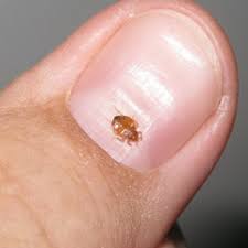 According to a survey, the most commonly infested places are the mattress (98.2%), boxspring. Tips Helpful Info Hager Pest Control