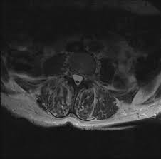 Definizione, ultime notizie, immagini e video dal dizionario medico del corriere della sera. Arachnoiditis Radiology Reference Article Radiopaedia Org