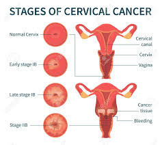 Cervical cancer pictures and videos. Flat Vector Illustration Of Stages Of Cervical Cancer Including Royalty Free Cliparts Vectors And Stock Illustration Image 147498327