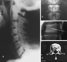 Picture frame vertebral body is a radiologic appearance in which the cortex of the vertebral body is thickened. The Spine In Paget S Disease Springerlink