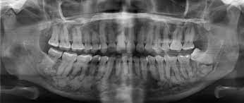 Maybe you would like to learn more about one of these? Cemento Osseous Dysplasia Wikipedia