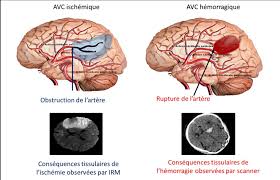 Véritable enjeu de santé publique, le pronostic vital de l'avc hémorragique peut être compromis le traitement de l'hypertension artérielle après la phase aiguë se justifie en prévention secondaire pour. L Accident Vasculaire Cerebral Institut Du Cerveau