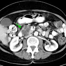 We did not find results for: Benign Multicystic Mesothelioma Of The Head Of The Pancreas Computed Download Scientific Diagram