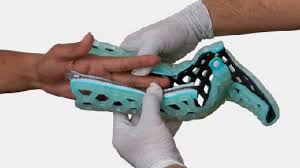 Image result for Ulnar Gutter Splint