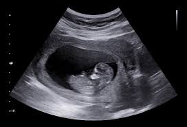 Image result for First Trimester Ultrasound