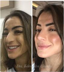 Os benefícios da harmonização facial