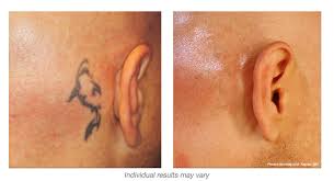 Maybe you would like to learn more about one of these? Hinsdale Picosure Laser Tattoo Removal Laser Aesthetic Center