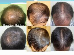 This formulation was given the brand name propecia. Dr Rajesh Rajput Hair Restore No Minoxidil No Finasteride Hair Fact Cyclical Nutrition Therapy Without Side Effects Assured Results In 3 4 Months Approved In Usa Canada Australia Avail 20 Discount On