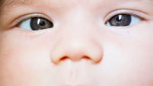 Causes And Treatments For Crossed Eyes In Newborns