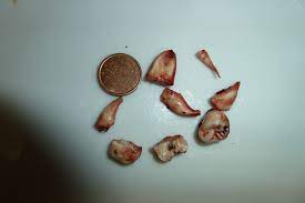 How to reduce wisdom teeth swelling reddit. Swelling After Wisdom Teeth Removal Reddit Teethwalls