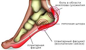 Bol V Pyatke Prichiny Prichiny Simptomy I Lechenie