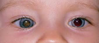 In addition to the congenital ocular symptoms. Norrie S Disease Gen Ndp Dnatests International