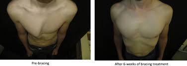 Sometimes the deformity isn't noticeable until after the adolescent growth spurt. External Compressive Bracing With Initial Reduction Of Pectus Carinatum Compliance Is The Key The Annals Of Thoracic Surgery