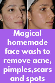 Pin On Essential Oils For Scars