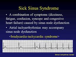 27 Sick Sinus Syndrome Ideas Heart Rhythms Syndrome Sick