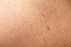 Wenn das der fall ist, deine haut in etwa so aussieht wie auf dem bild oben und typische behandlungsmethoden von akne oder unreinheiten keine. Reibeisenhaut Keratosis Pilaris Was Hilft