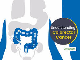 Colon cancer most often develops from precancerous growths, also known as polyps. Colorectal Cancer Awareness Month 2021 Symptoms Causes And Treatment Of Colon Cancer
