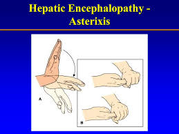 It's also accompanied by irregular and involuntary jerking movements. Topics In Gastroenterology Ppt Download