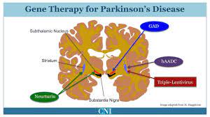 New Treatment Symptomatic Treatment Of Parkinson S Disease Youtube