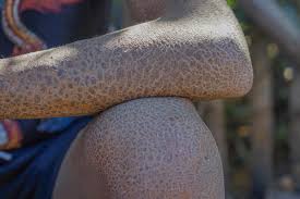 Image result for Ichthyosis