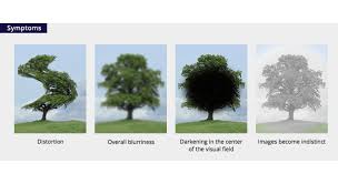 Image result for Visual Field Deficit