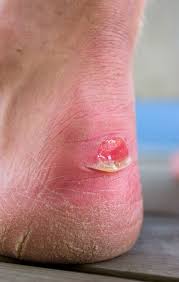 Blood blister on foot under skin. Foot Blisters Treatment Relief Orthotic Shop