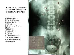 Image Result For Where Is The Kidney Ureter And Bladder In Relation To Left Transverse Processes Of L4 Bladder Relatable Pelvis
