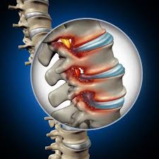 When the discs are damaged, you'll likely experience intense pain, along with difficulty moving and stabilizing yourself. Spinal Stenosis From A Car Accident
