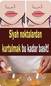 yumurta aki maskesi nasil yapilir cilde faydalari cilt bakimi siyah noktalar siyah lekeler dogal