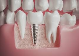 Aesthetic vs. Functional Goals: Different Approaches to Implant Dentistry |  Dentist Wigston