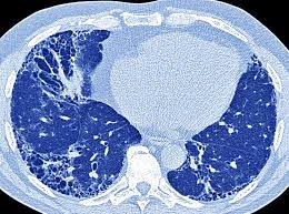 Rheumatoid Arthritis Extra Articular Manifestations Challenges Of Interstitial Lung Disease Rheumatology Advisor