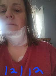 What are common post-operative experiences after Inspire surgery for sleep  apnea?